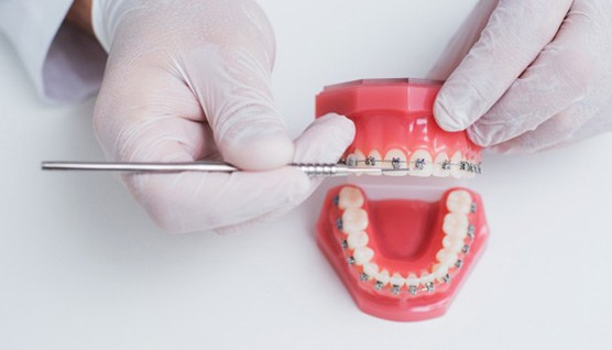 dentist pointing to braces that are on a model of a mouth