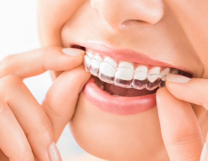 Close-up of woman’s smile with Angel Aligner in Queens