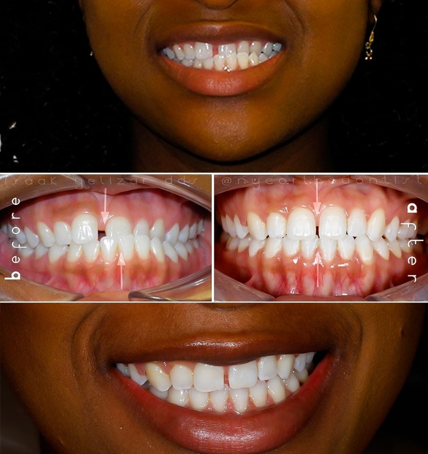 Smile before and after crossbite treatment