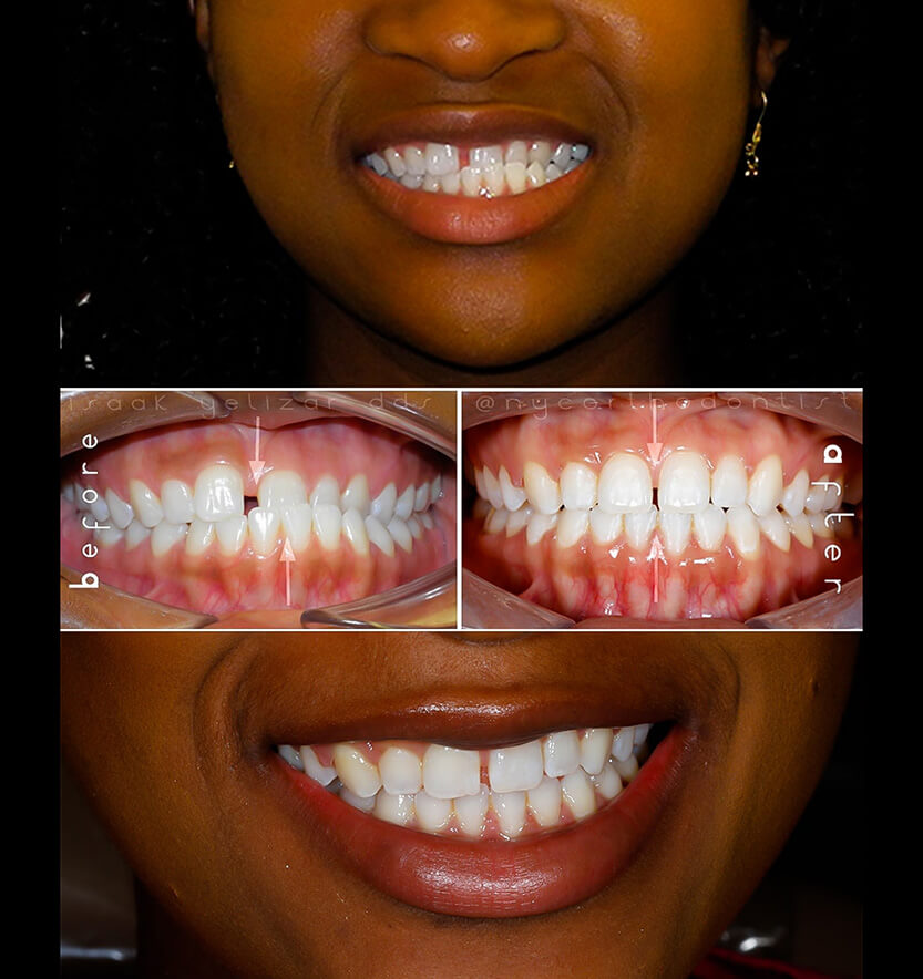 Smile before and after crossbite treatment