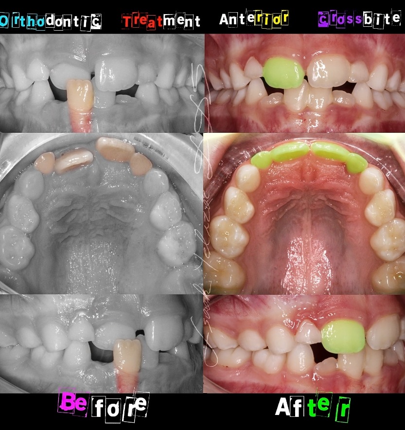 Intraoral images of smile before and after crossbite treatment