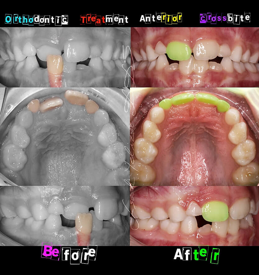 Intraoral images of smile before and after crossbite treatment