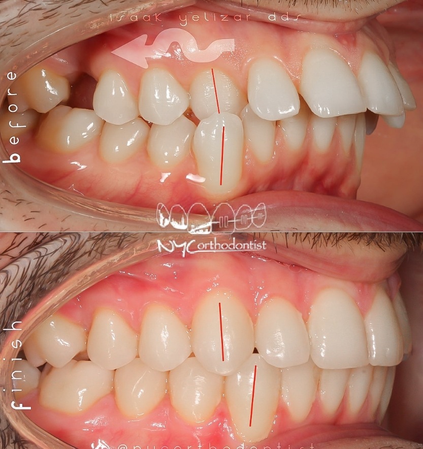 Side view of smile before and after crossbite treatment