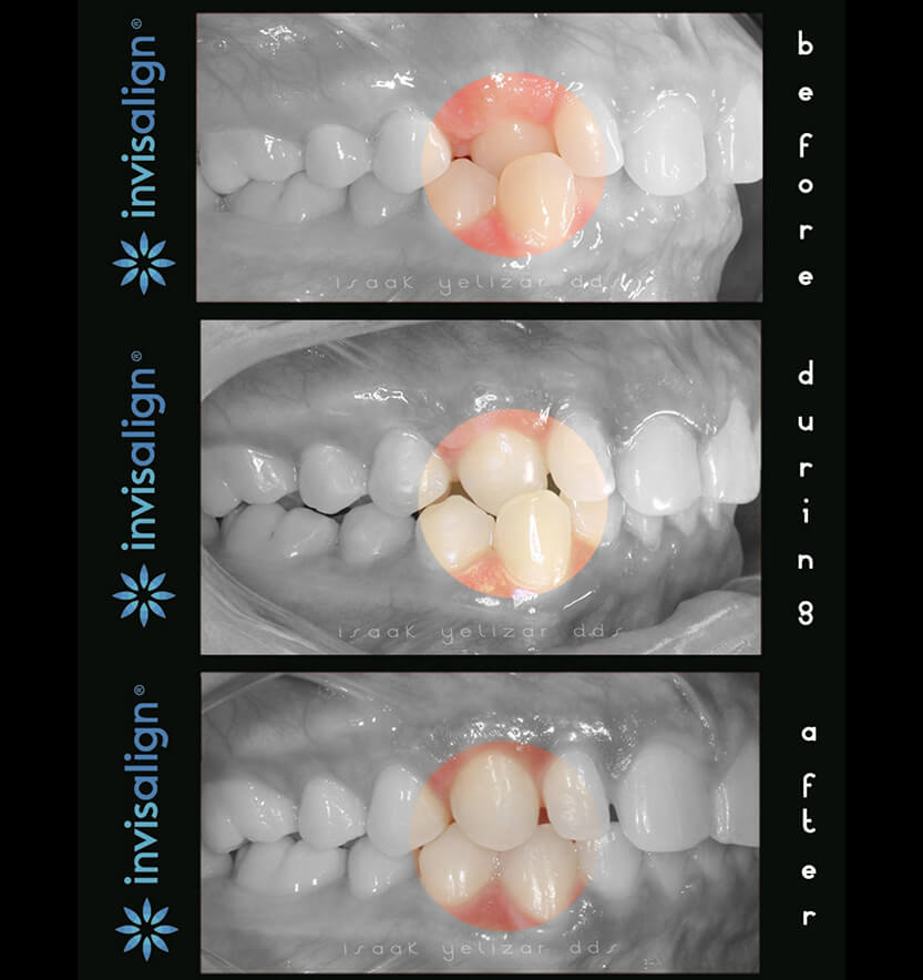 Side view of smile before during and after Invisalign treatment for crossbite