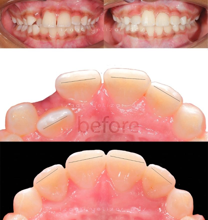 Closeup and intraoral images of smile before and after crossbite treatment