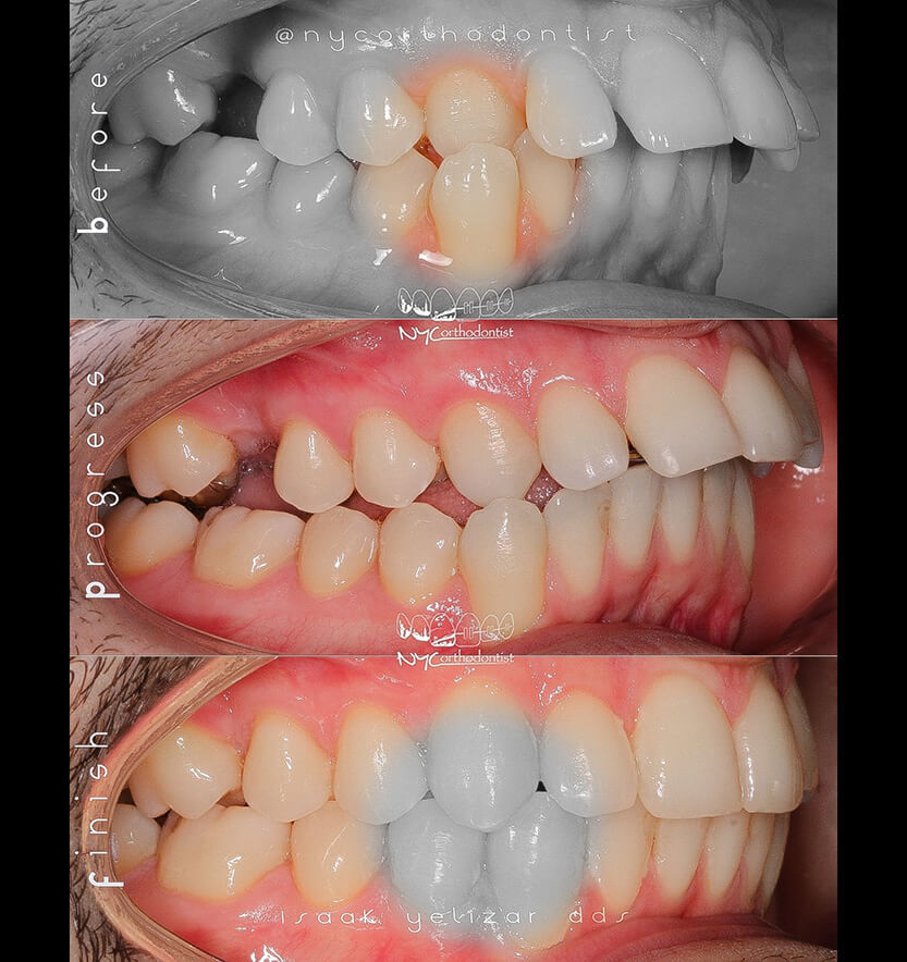 Smile before during and after crossbite treatment