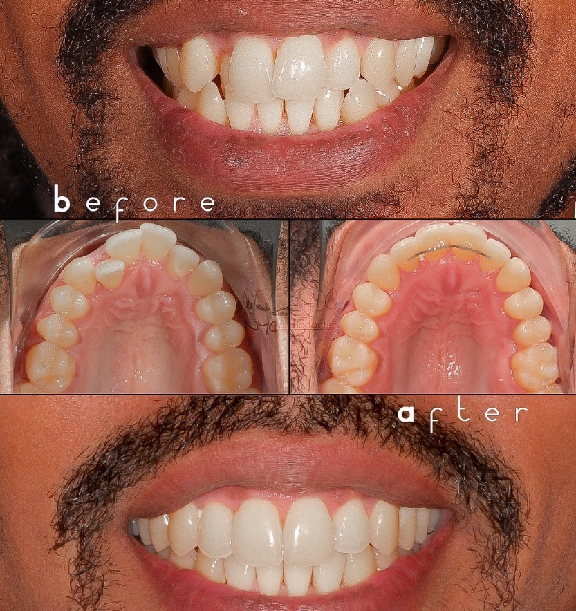 Full smile and inside bottom teeth before and after crossbite treatment