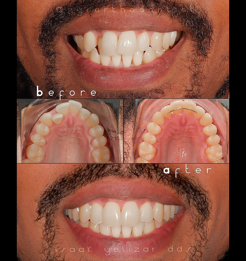 Full smile and inside bottom teeth before and after crossbite treatment