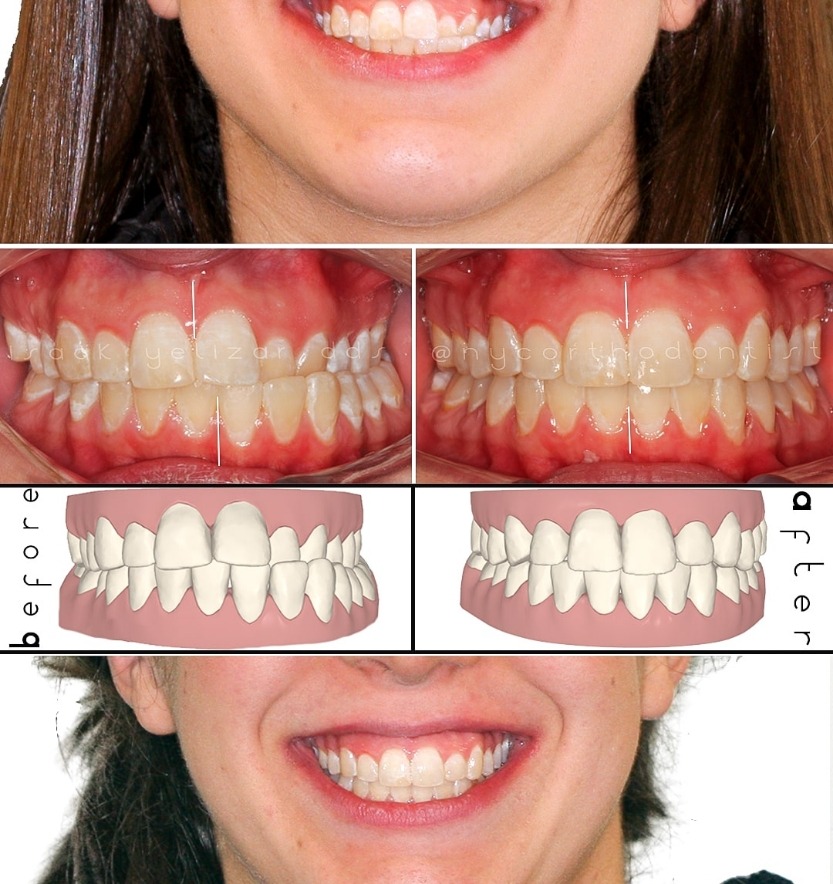 Smile before and after orthodontic treatment for severe crossbite