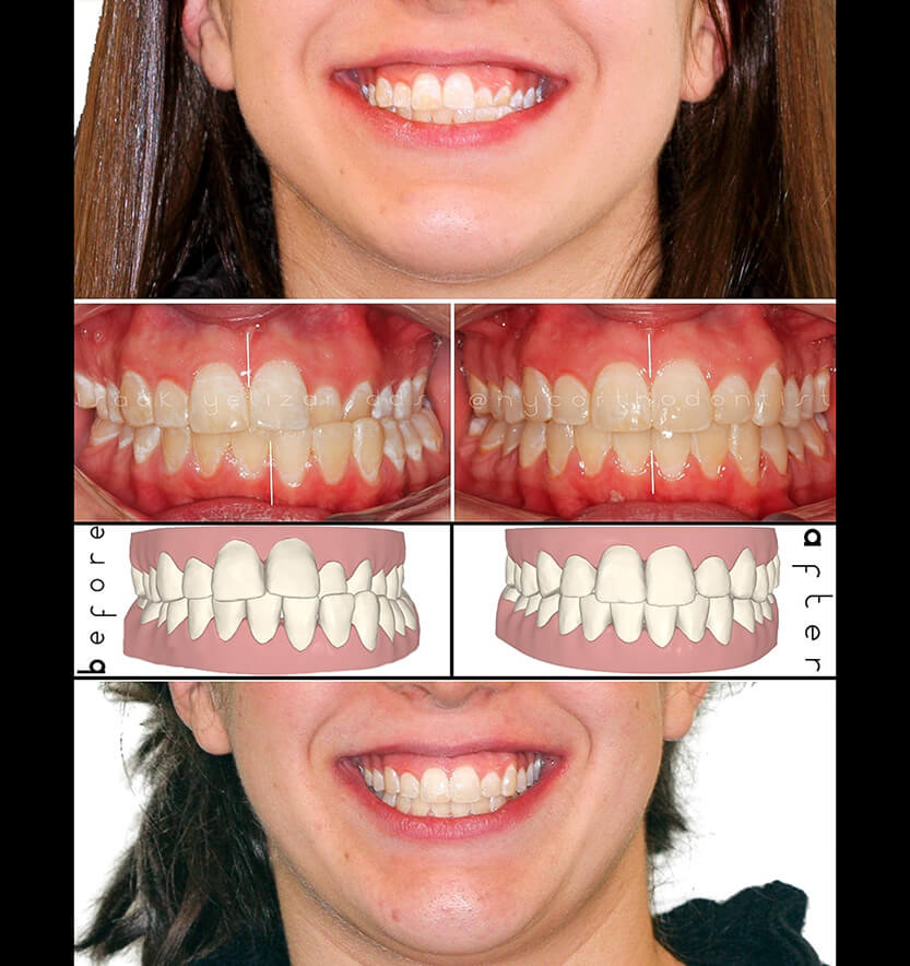 Smile before and after orthodontic treatment for severe crossbite