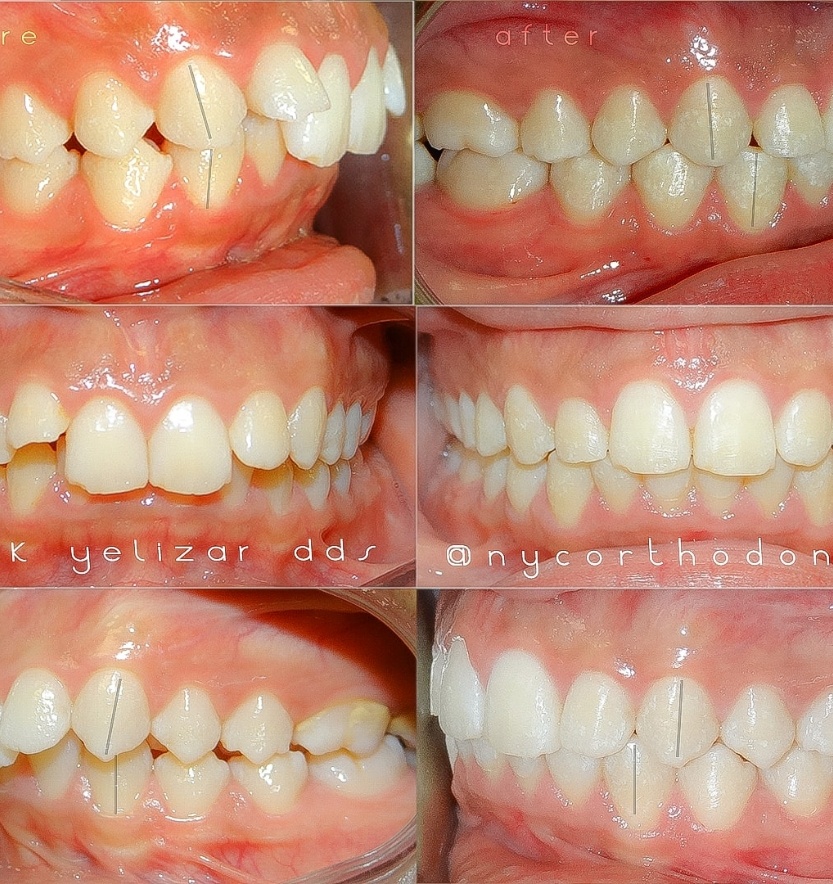 Smile before and after treatment for class two bite alignment issues