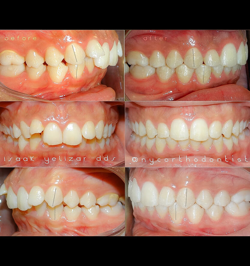 Smile before and after treatment for class two bite alignment issues