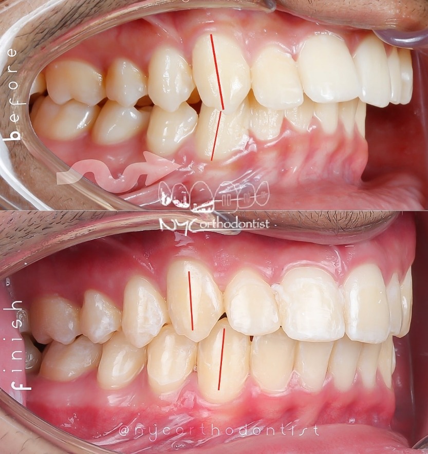 Patient's profile and closeup of smile before and after orthodontic treatment
