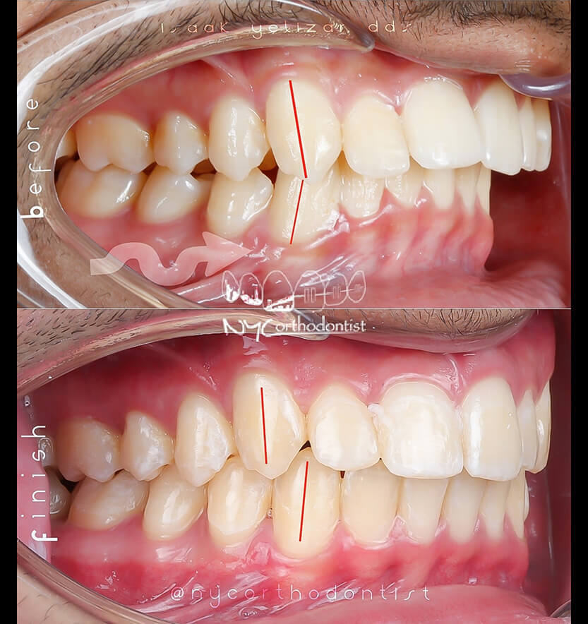 Patient's profile and closeup of smile before and after orthodontic treatment