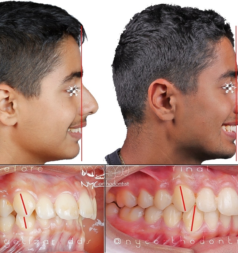 Smile before and after incognito orthodontic treatment for class two bite alignment issues