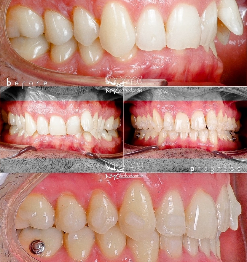 Front and side view of patient's smile before and after orthodontic treatment for class two bite alignment
