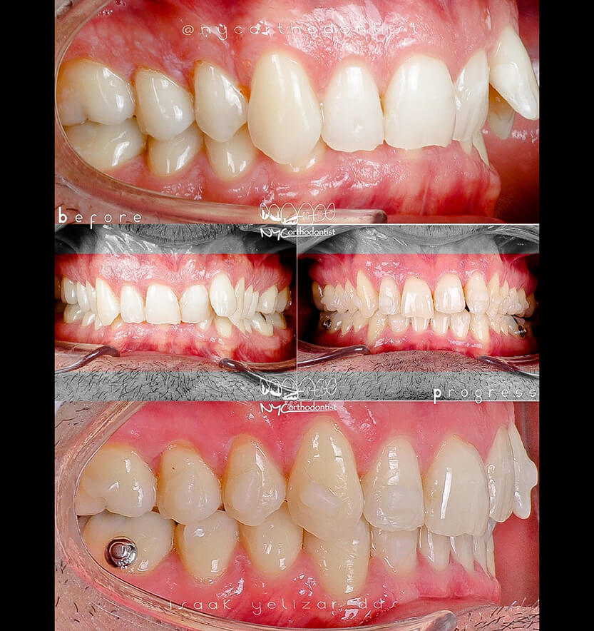 Front and side view of patient's smile before and after orthodontic treatment for class two bite alignment