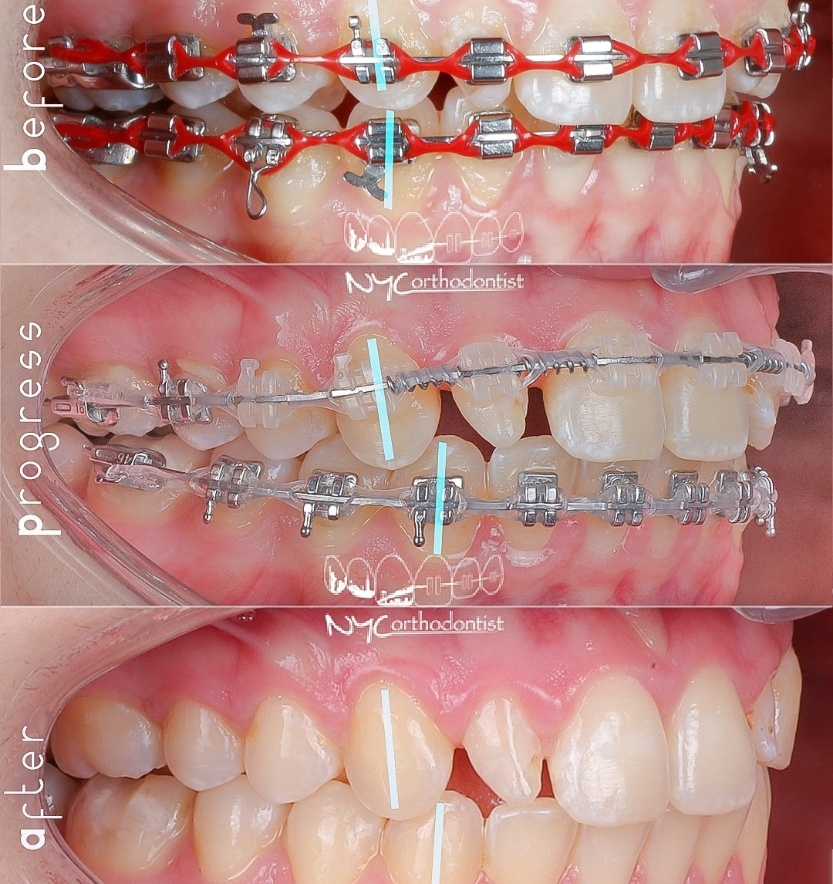 Smile during and after treatment for class two bite alignment issues