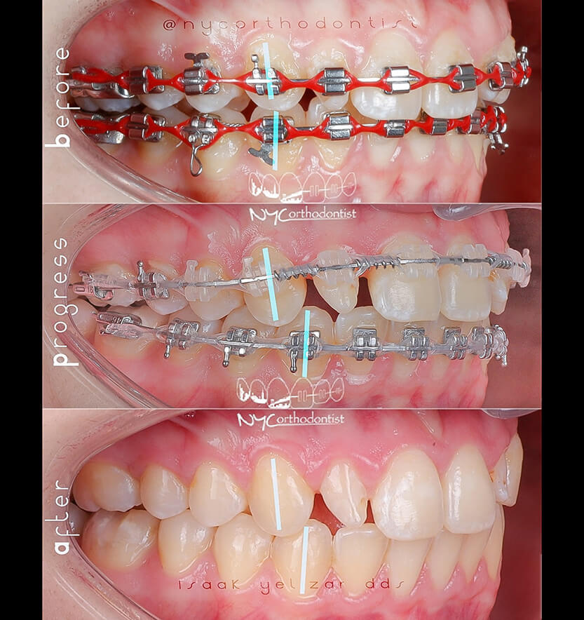 Smile during and after treatment for class two bite alignment issues