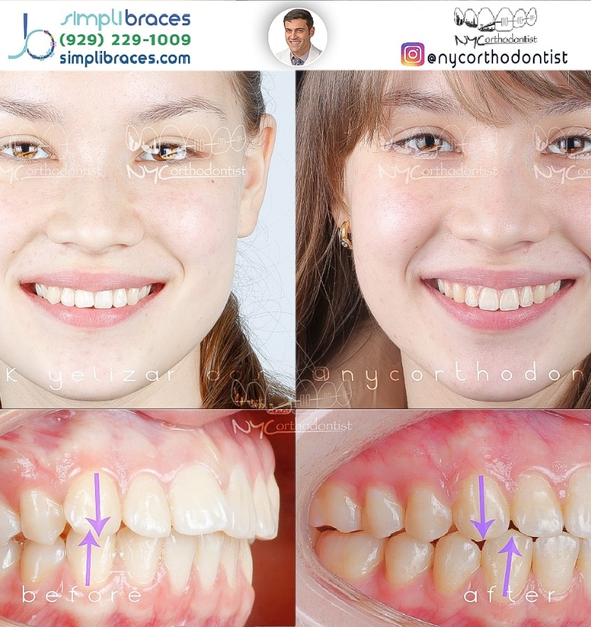 Young woman's smile before and after treatment for class two bite alignment issues