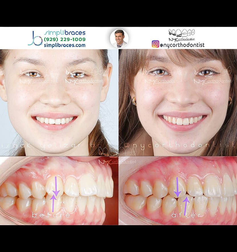 Young woman's smile before and after treatment for class two bite alignment issues