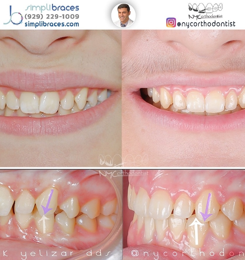Closeup of smile before and after treatment for class two bite alignment issues