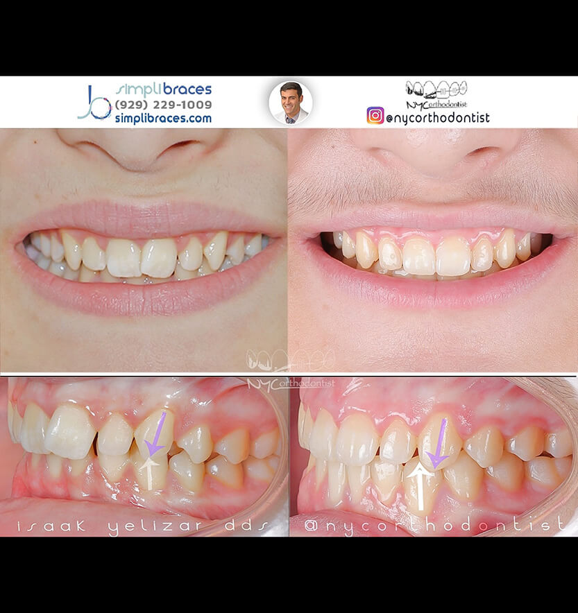 Closeup of smile before and after treatment for class two bite alignment issues