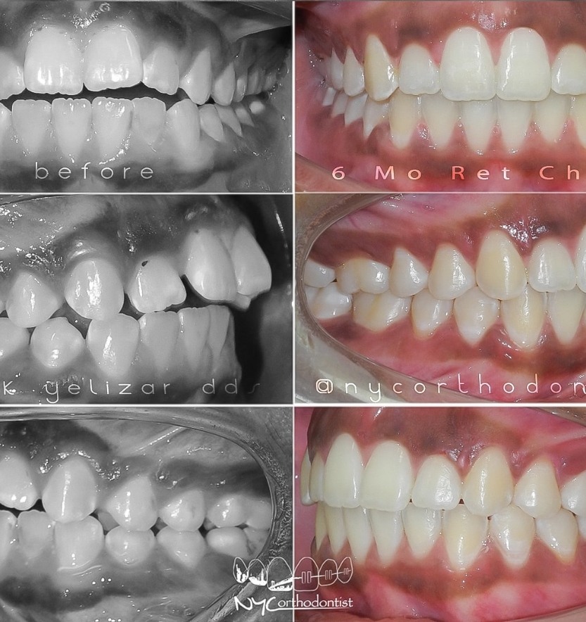 Patient's smile before and after treatment for class two bite alignment issues