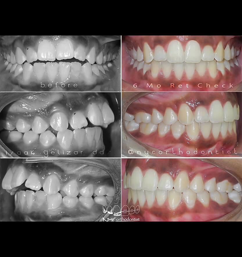 Patient's smile before and after treatment for class two bite alignment issues