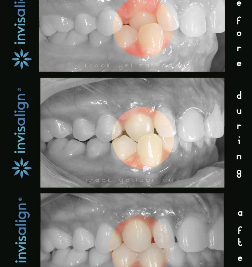 Smile before during and after treatment for class two bite alignment issues