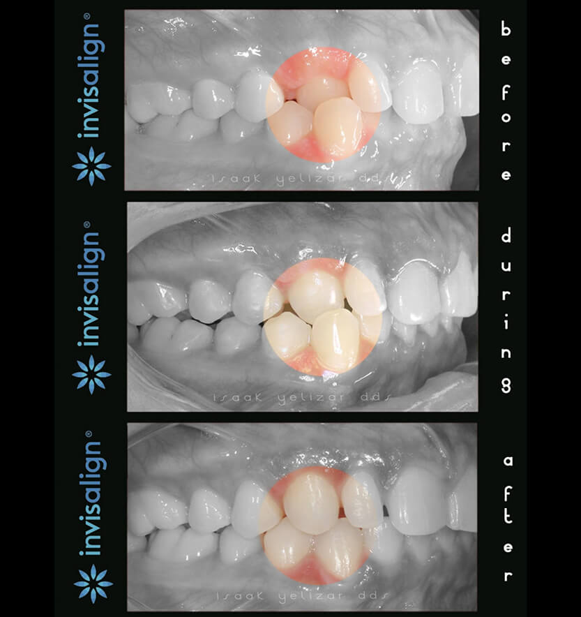 Smile before during and after treatment for class two bite alignment issues