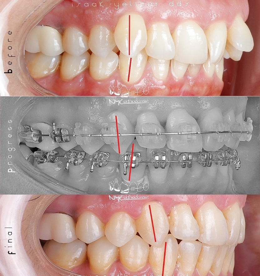 Closeup of patient's smile before and after treatment for class two bite alignment issues