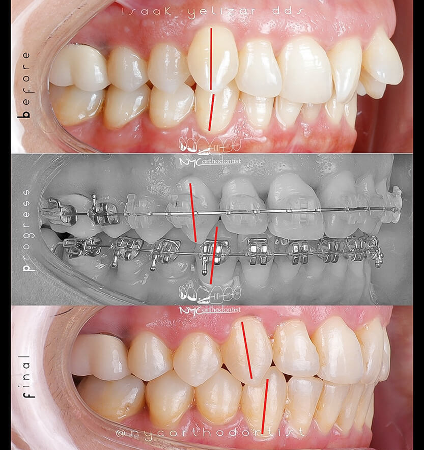 Closeup of patient's smile before and after treatment for class two bite alignment issues