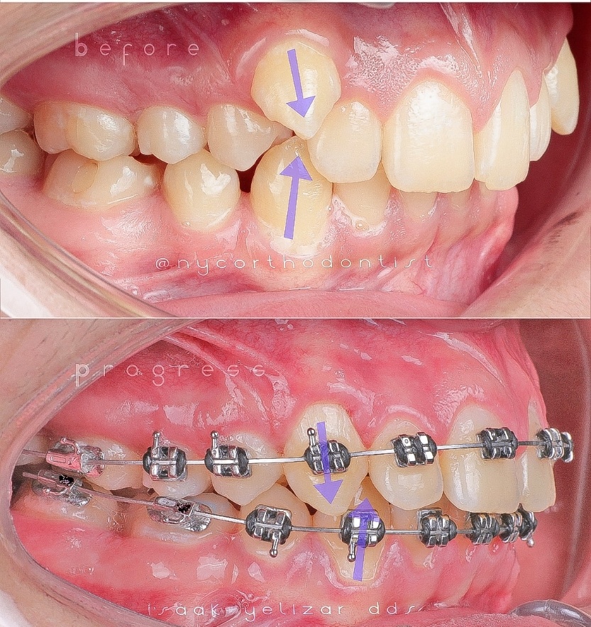 Side and front views of smile before and after treatment for class two bite alignment issues