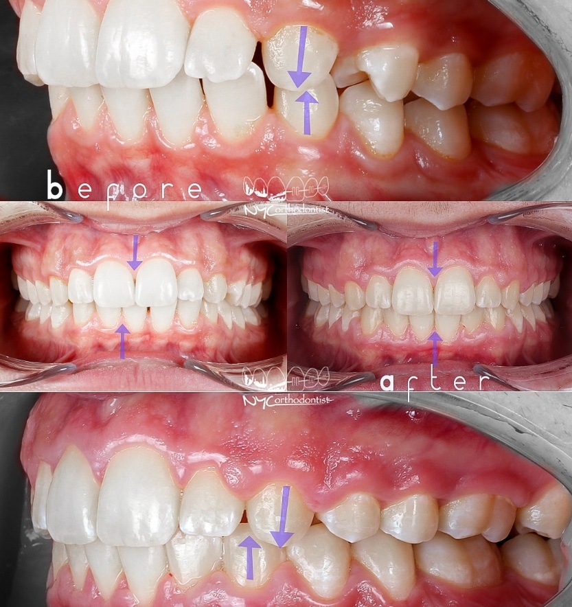 Patient's smile before and after orthodontic treatment for class two bite alignment issues