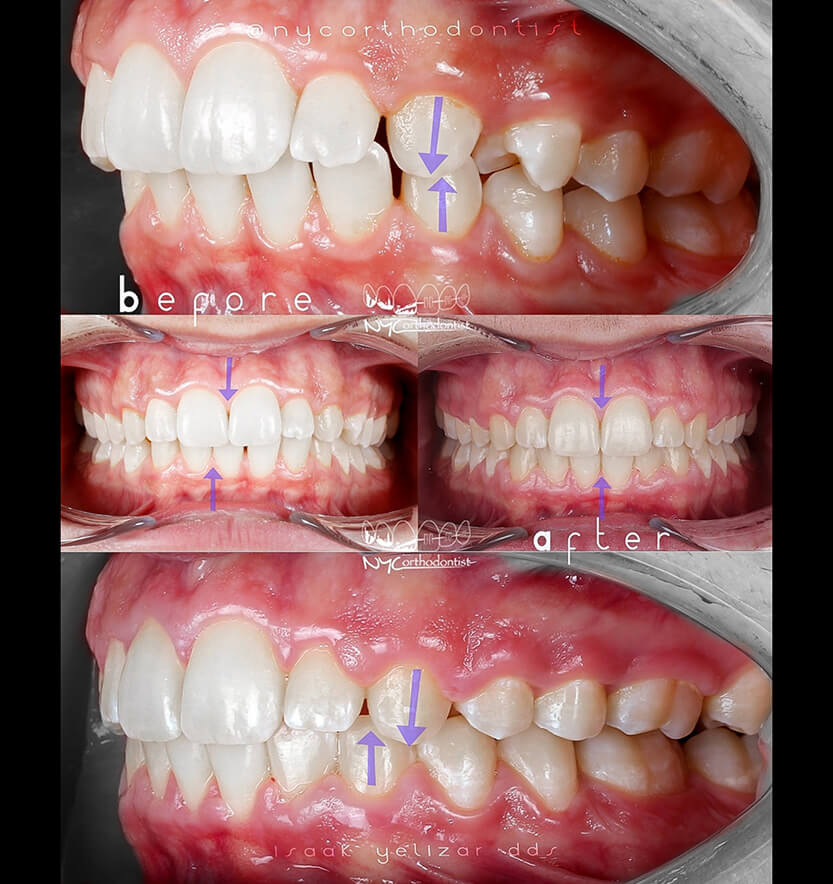 Patient's smile before and after orthodontic treatment for class two bite alignment issues
