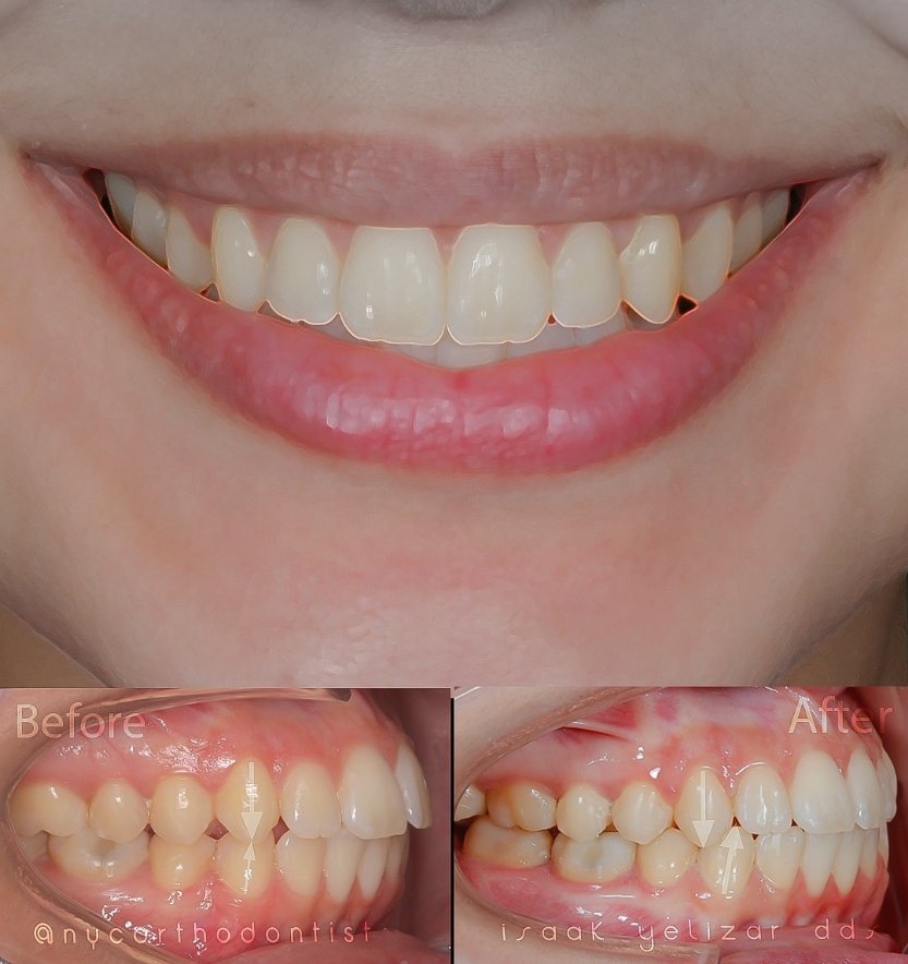 Smile before and after treatment for severe class two bite alignment issues