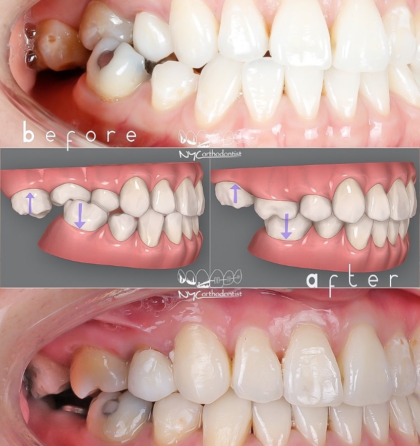 Animated smile showing plan and patient's smile before and after treatment for crossbite