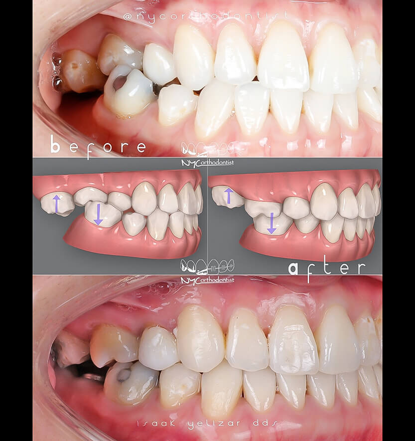 Animated smile showing plan and patient's smile before and after treatment for crossbite