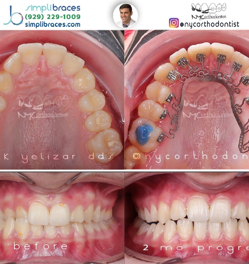 Front of smile and inside bottom teeth before and after treatment for crossbite