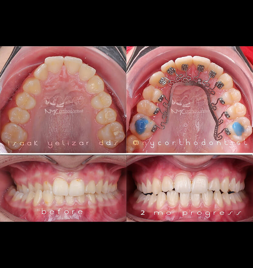 Front of smile and inside bottom teeth before and after treatment for crossbite