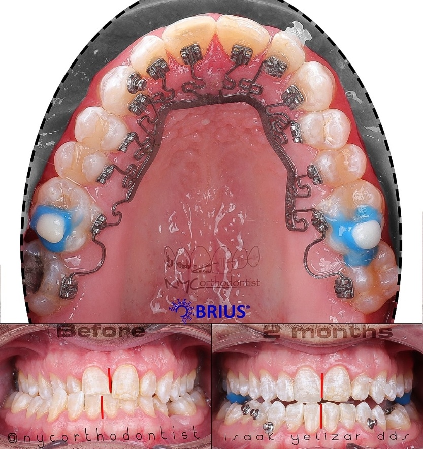Inside of bottom teeth during treatment and front of smile before and after treatment for crossbite