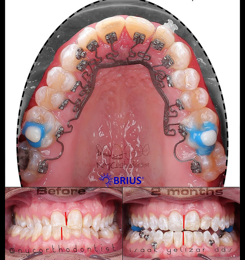 Inside of bottom teeth during treatment and front of smile before and after treatment for crossbite