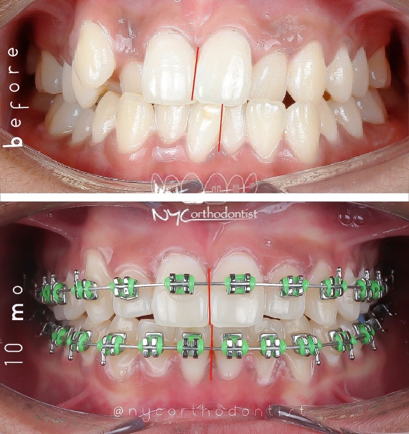 Front of smile before and after treatment for crowding