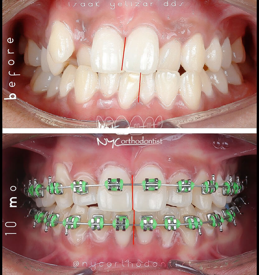 Front of smile before and after treatment for crowding