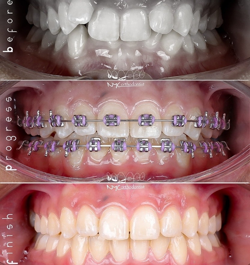 Closeup of smile before during and after orthodonic crowding treatment