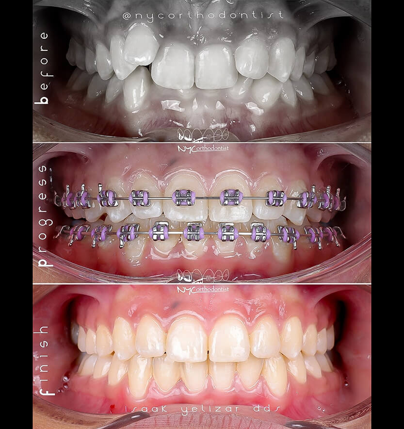 Closeup of smile before during and after orthodonic crowding treatment