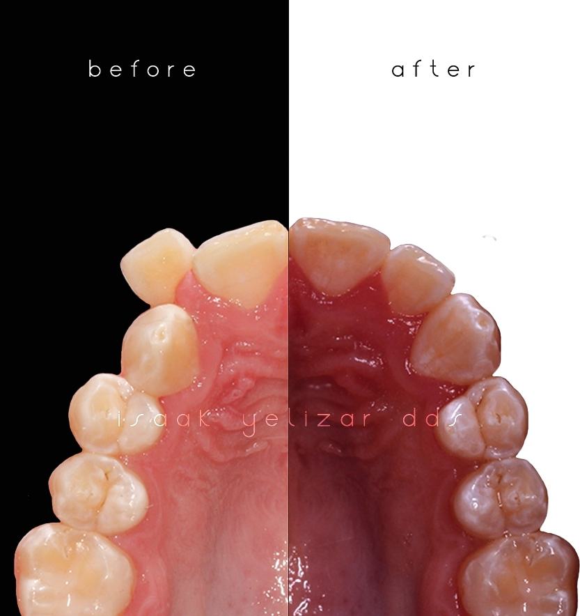 Comparing inside of bottom teeth before and after orthodontic crowding treatment