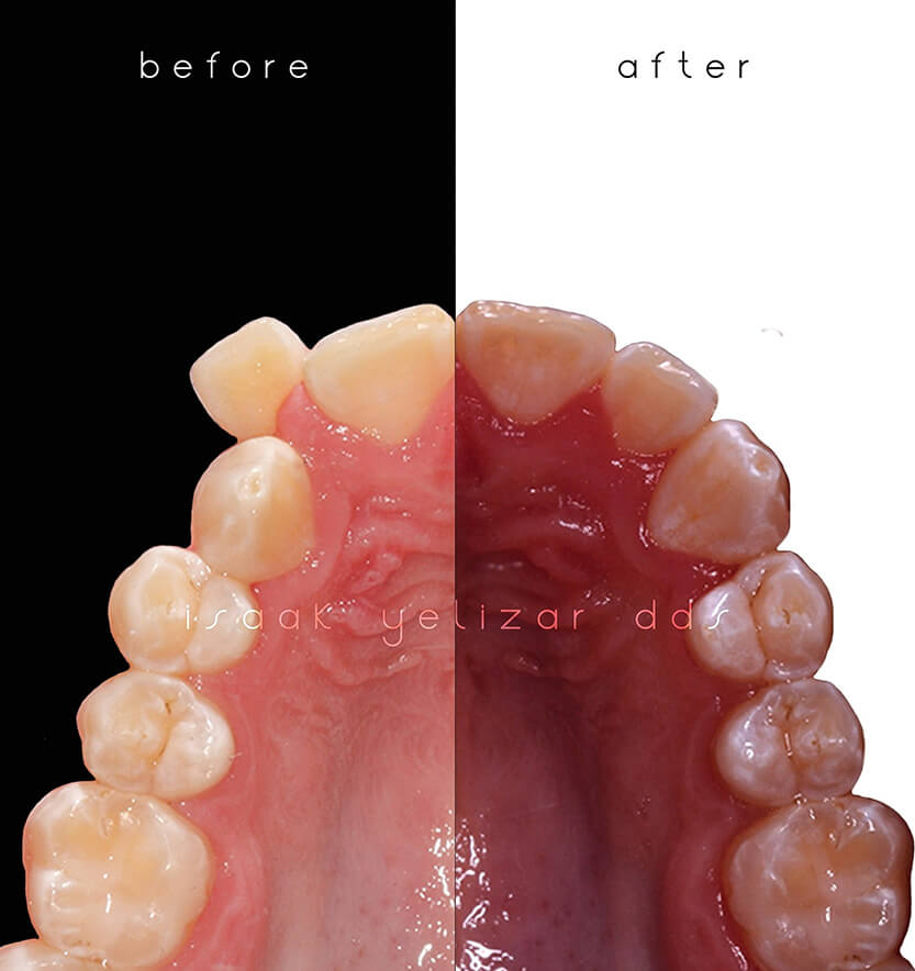 Comparing inside of bottom teeth before and after orthodontic crowding treatment