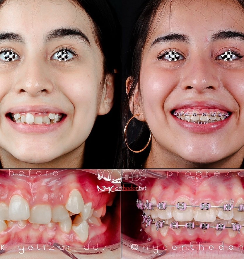 Front view of patient's smle and closeup before and after orthodontic crowding treatment